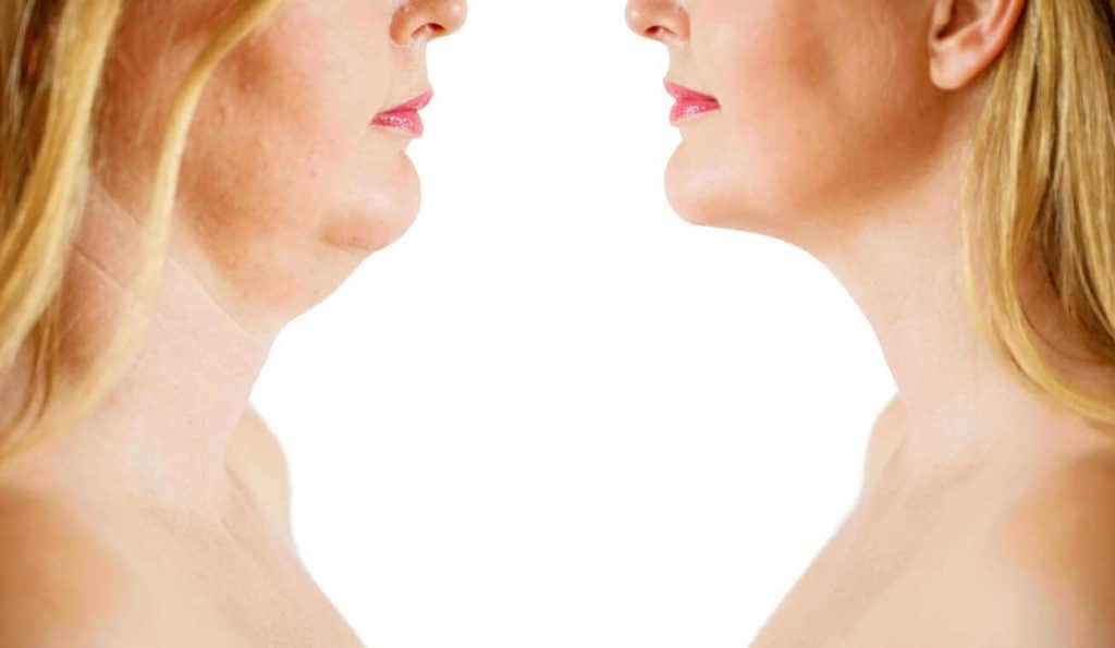Double Chin treatment Edinburgh before and after results