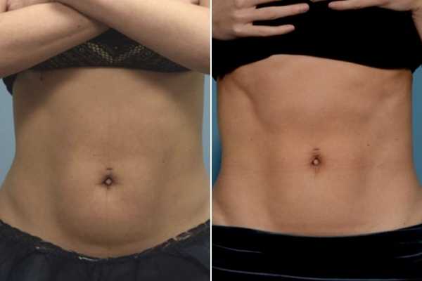 body sculpting FAQs Edinburgh