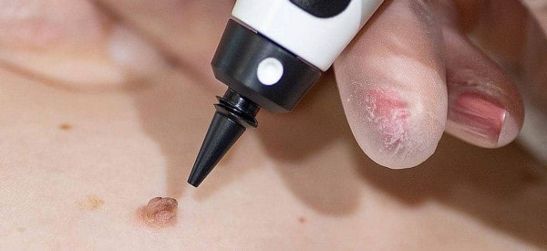 After Skin Tag Removal Edinburgh