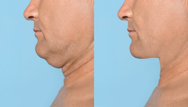 Which Non-Surgical Treatments Work Best for Jowls and Loose Skin Edinburgh?