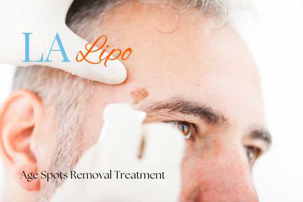 What Are the Most Effective Treatments for Age Spots Edinburgh?
