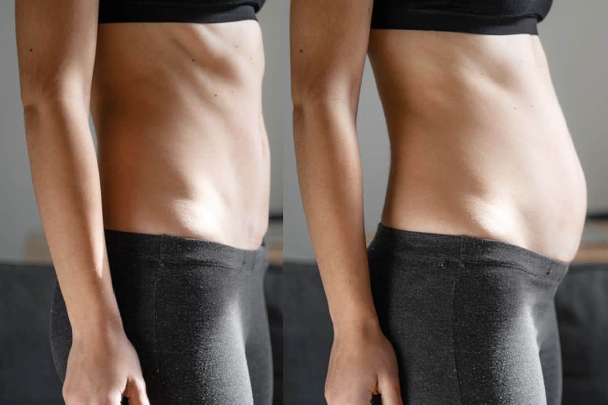 How long does diastasis recti take to improve Edinburgh?