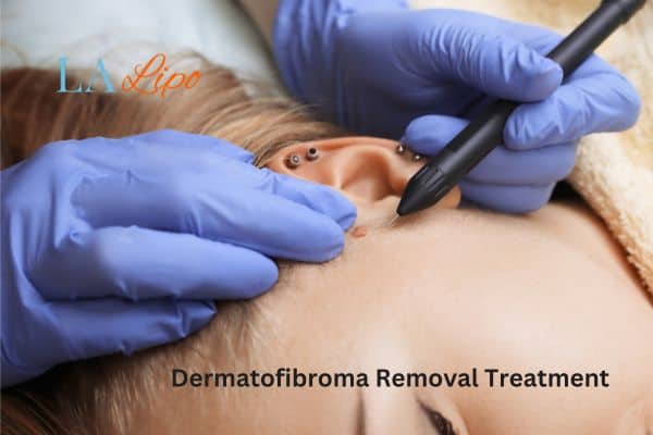 Dermatofibroma Removal Treatment Edinburgh