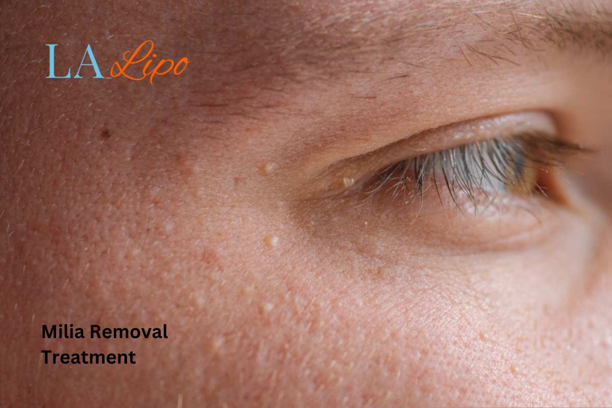 Cryopen Milia Removal: Is It the Easiest and Safest Option Edinburgh?