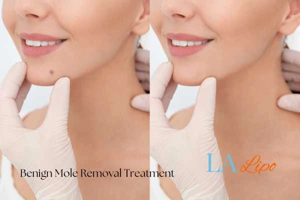 Before-and-after results following benign mole-removal treatment Edinburgh