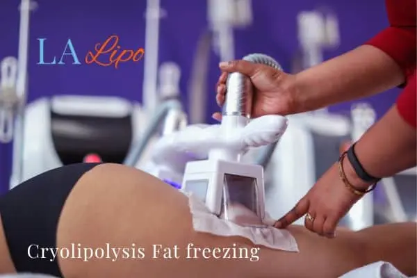 women getting fat freezing Edinburgh