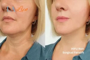hi-fu for wrinkles Edinburgh before and after results
