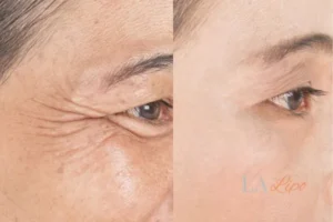 Before and after results of woman - HI-fu wrinkles reduction treatment Edinburgh