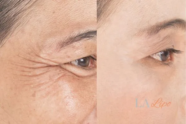 Before and after results of woman - HI-fu wrinkles reduction treatment Edinburgh