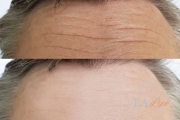 results of HIFU Edinburgh on mans forehead to help reduce lines and wrinkles