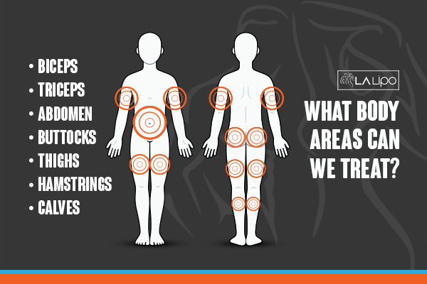 Graphic to show areas you can have LA-EMS Body Sculpting Edinburgh treatment.