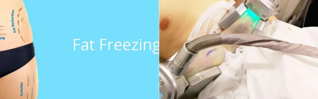 Fat freezing Edinburgh on multiple areas of the body