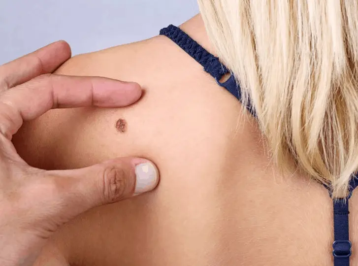woman having mole removal Edinburgh consultation before treatment.