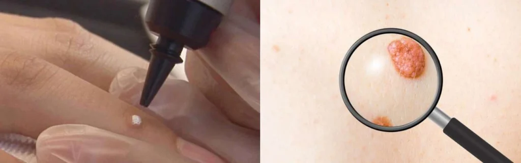CryoPen practitioner Edinburgh assessing a benign mole before treatment