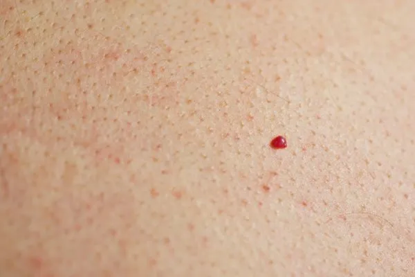 close up of a cherry angioma Edinburgh