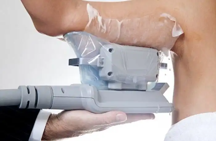 Picture of fat freezing Edinburgh on the upper arms.