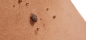 image of a skin tag Edinburgh