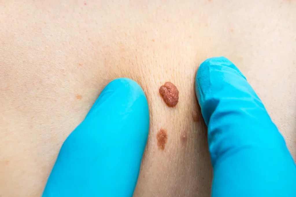 Consultant examining a skin tag Edinburgh