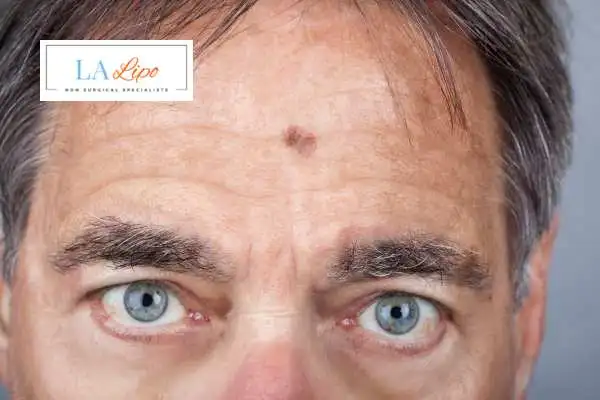 Solar Lentigo Removal Edinburgh image of man with mark on his forehead