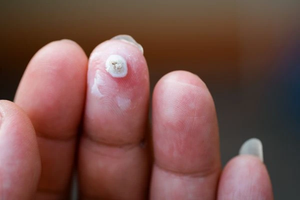 wart on person finger - cryotherapy to treat from LA LIPO Edinburgh