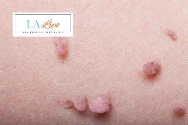 Does cryopen skin tag removal Edinburgh hurt? Find out now call our team today!