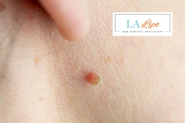 Book skin tag removal Edinburgh today speak to our team now!