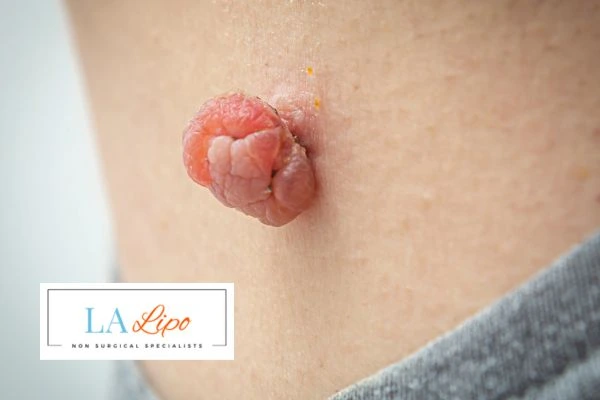 Interested in skin tag removal Edinburgh? Concerned about the pain? Find out more today!