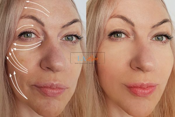 Morpheus 8 results Edinburgh face lift.
