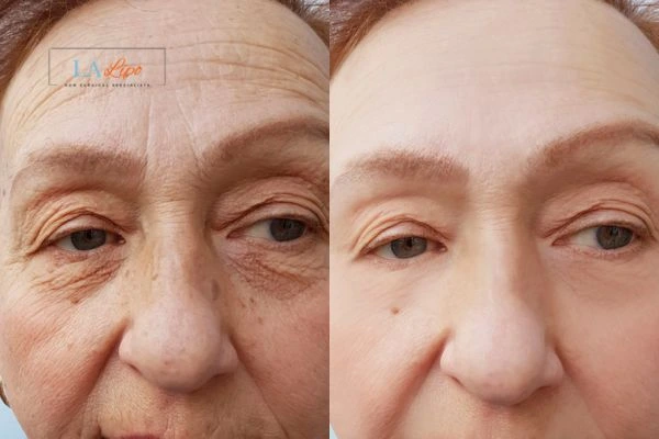 The powerful benefits of Morpheus8 Treatment Edinburgh - Call Our team today!