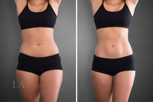 before and after results of non-surgical treatment to help a woman's body image and mental health Edinburgh