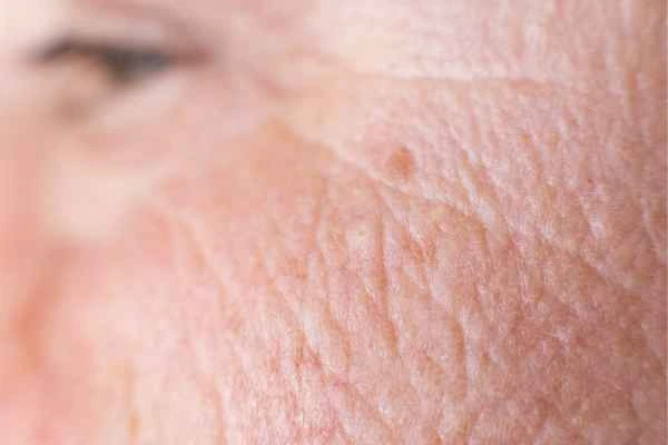 close up picture of a woman's face showing an age spot Edinburgh