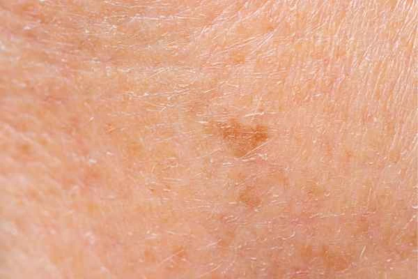 close up picture of age spots Edinburgh