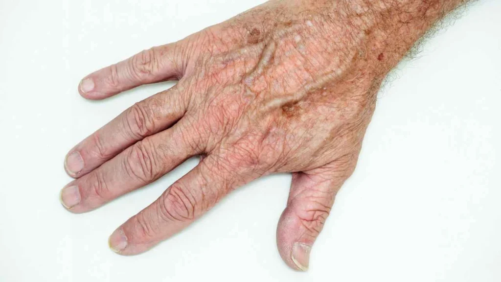 Male hand showing age spot Edinburgh