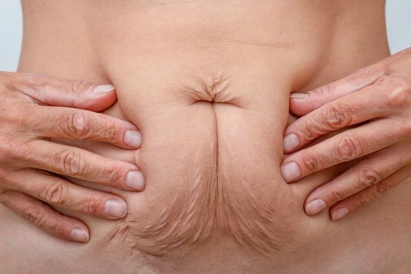 Should I Combine Diastasis Recti Treatment with Body Contouring for Better Results Edinburgh?